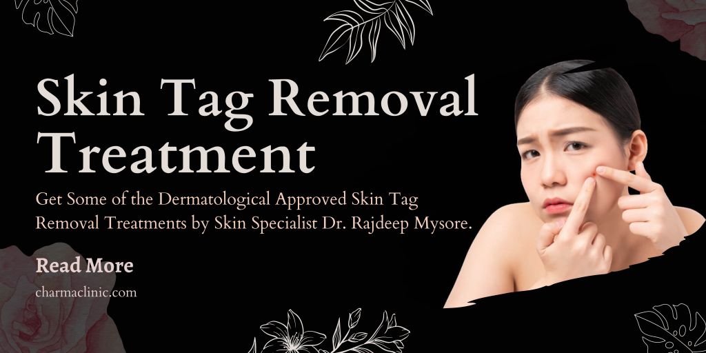 Skin Tag Removal Guide By Dermatologist